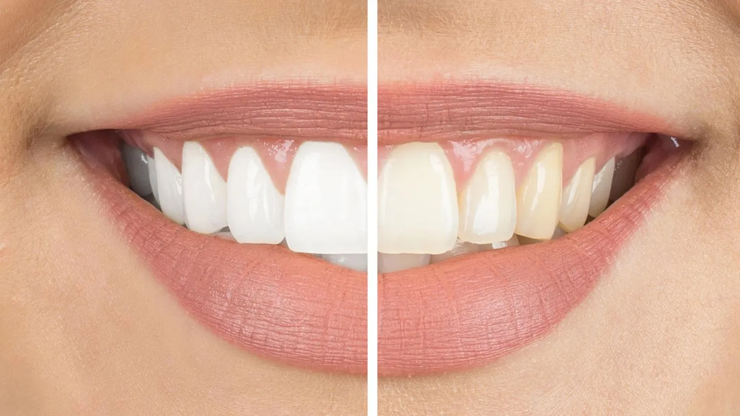 Bleaching von Zahnarztpraxis Bergmann 